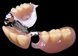 ノンクラスプ義歯の仕組み
