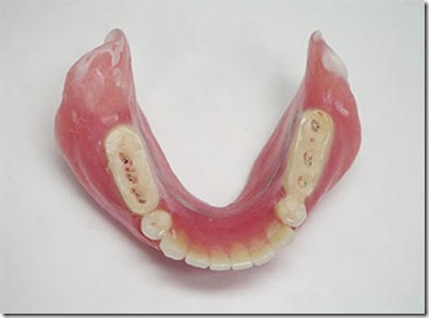 治療用義歯の仕組み