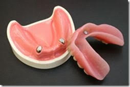 マグネットアタッチメント義歯の仕組み